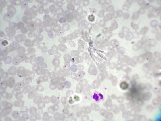 Plasmodium falsiparum, intraerythrozytär, überwiegend Siegelringstadium (sog. Trophozoiten)